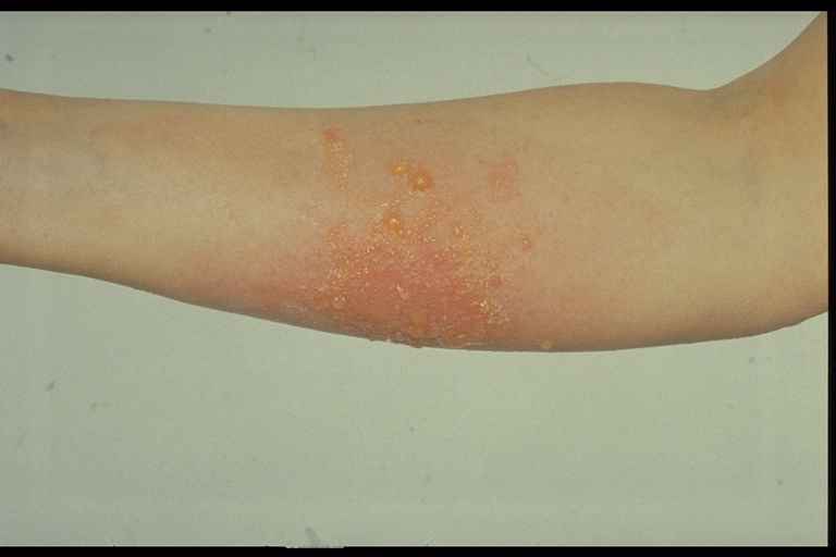 Plant Dermatitis