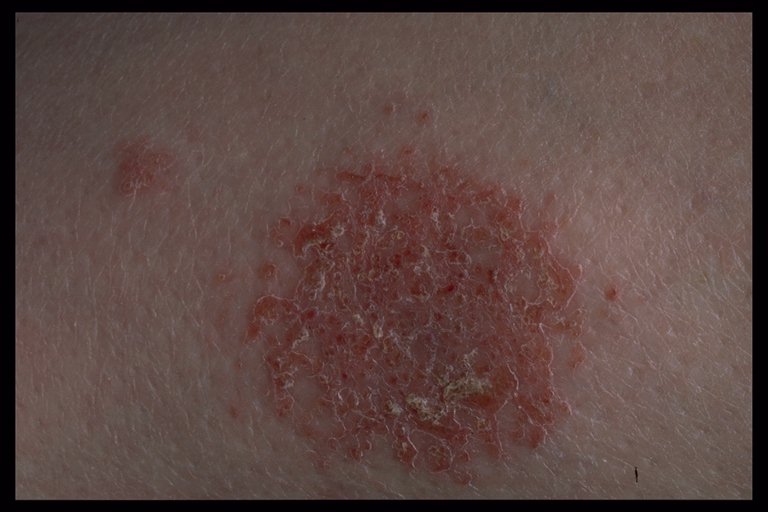 Discoid Eczema Pictures Photos