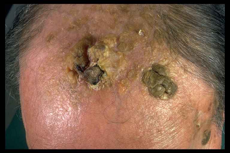 Squamous cell carcinoma | DermNet New Zealand