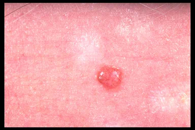 what is basal cell carcinoma