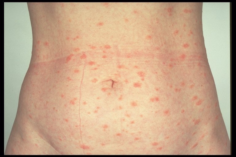 dermatology imagebank pityriasis rosea dermatology imagebank pityriasis rosea