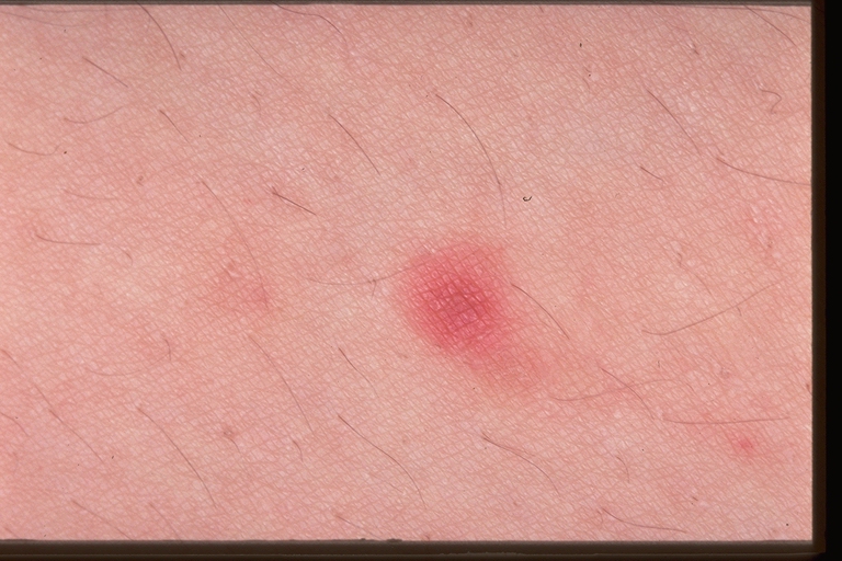What are Papules? (with pictures) - wiseGEEK